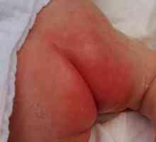 Pelene dermatitis: liječenje, simptomi i uzroci od požara