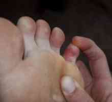 Fraktura malog prsta na nozi: Prva pomoć
