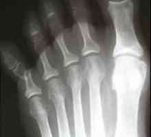 Frakture prstiju: uzroci, simptomi i tretmani
