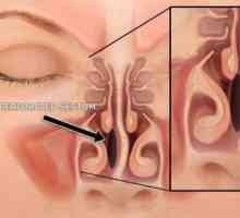 Perforacije nosne pregrade: uzroci, simptomi, liječenje i učinci