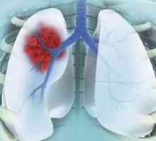 Periferni rak pluća: faza, liječenje, medicinsku povijest. Periferni pluća udio raka