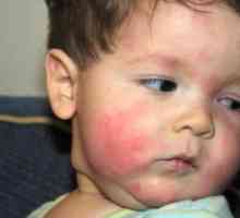 Alergije na hranu u djece: što učiniti?