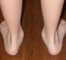 Iz bilo kojeg razloga, razvijaju ravnim valgus stopala u djece i kako ih liječiti?