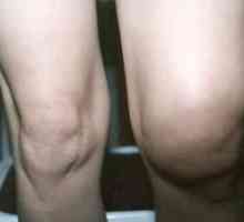 Zašto koljena bubri i bolovima? Uzroci i liječenje