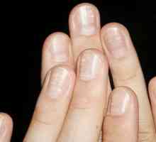 Zašto nokti pojavljuju bijele mrlje, i što mogu reći?