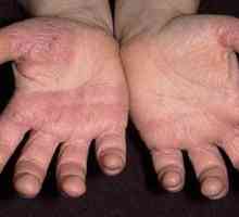Zašto gljivica kože na svojim rukama i kako ga izliječiti?