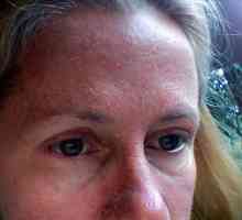 Zašto ljuskava koža na licu? Uzroci i liječenje