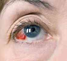 Zašto praska krvne žile u očima: uzroci i liječenje