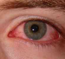 Crvenilo očiju: uzroci pojave