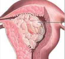 Endometrija polipa, što je to? Uzroci, simptomi i tretman metode