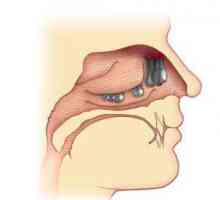 Nosni polipi: liječenje bez operacije. polipa u nosu Treatment narodnih lijekova