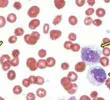 Povišene monocita u krvi - što to znači?