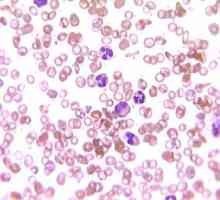 Povišeni bijelih krvnih stanica u krvi: što je uzrok, a što je tretman?
