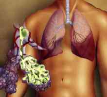 Pravo-sided upala pluća: uzroci, simptomi i tretman