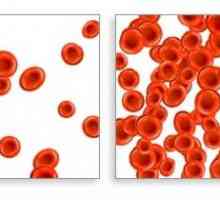Željezo dodataka za anemije: pro i kontra