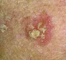 Koje bolesti ljuskave flastera na kožu?