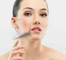 Uzrokovati unutarnje prištiće na licu. Kako ukloniti unutarnje akne na licu?