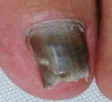 Uzroci simptomi i tretman noktiju onikomikoza