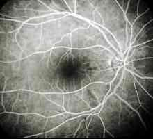 Uzroci, simptomi i liječenje mrežnice angiopatije