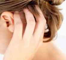 Uzroci, simptomi i liječenje seborrheic dermatitis na glavi