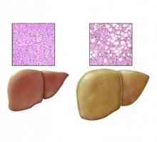 Uzroci, simptomi i liječenje masne jetre