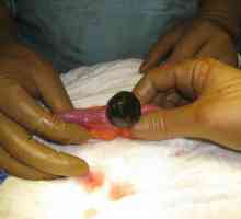 Uzroci, simptomi, liječenje i uklanjanje kamenja iz žučnog mjehura