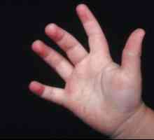 Znak bilo koje bolesti je osip u djeteta noge i ruke