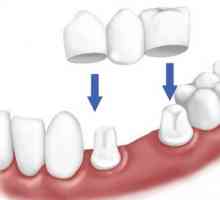 Proteza u nedostatku velikog broja zuba: Tipovi