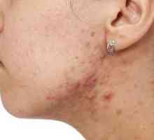 Akne kod žena u vratu: uzroci, prevencija i liječenje