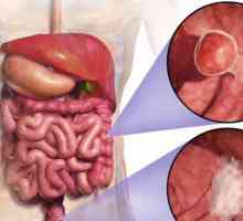 Rak debelog crijeva živjeti mnogo? Prognoza: koliko je ostalo da živi
