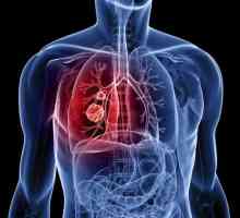 Rak pločastih stanica pluća: opis, uzroci, dijagnoza i liječenje značajke