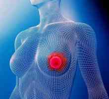 Rak dojke, Korak 2a: prognoza. rak dojke fazi 2a pomiješa?