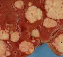 Rak jetre: znakovi bolesti i sve što je potrebno znati o tome