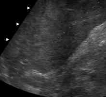 Dimenzije normalnog ultrazvučno jetre (transkript)