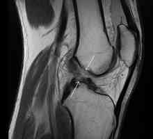 Rupture prednjeg križnog ligamenta: zašto se to događa i kako to popraviti?