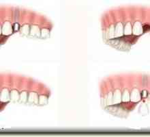 Zub obnova: kada i kako primijeniti postupak?