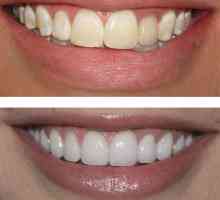 Sanacija zubi prije i poslije. Naracija zubni nadomjestak