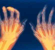 Reumatoidni artritis: simptomi i tretman ovisnosti o drogama i narodnih lijekova