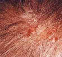 Seboreični dermatitis na glavi: liječenje i klinička slika