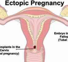 Cervikalna trudnoća: uzroci, simptomi, dijagnoza