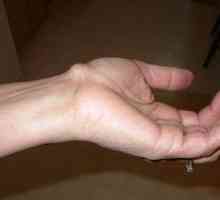 Paušalni pod kožu na ruci - to može biti i kako liječiti?
