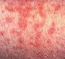 Simptomi infekcije citomegalovirusom i dijagnoze