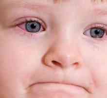 Simptomi i liječenje konjunktivitisa u djece
