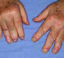 Simptomi i liječenje psorijatični artritis