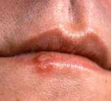 Simptomi raka usta - kako ih prepoznati?