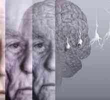 Demencija sindroma ili demencije