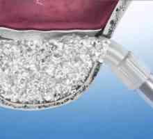 Sinus lift: korištenje u dentalnih implantata. Vrste, indikacije, moguće komplikacije