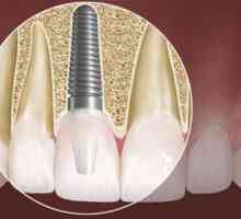 Koliko je umetnuti zube? Dentalni implantati - alternativni način da se vrate na svoje bivše…