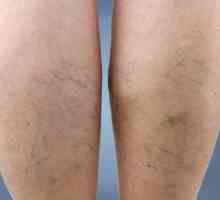Vaskularne mreže na nogama: kako da biste dobili osloboditi od uzroka i obilježja tretmana