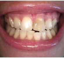 Suvremena stomatologija: jedan izbjeljivanje zuba